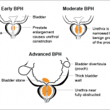 Benign prostatic hypertrophy