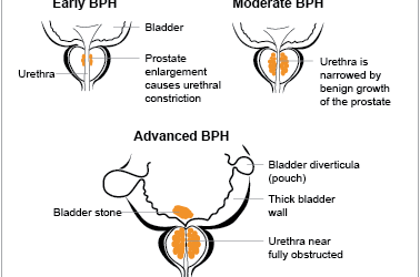Benign prostatic hypertrophy