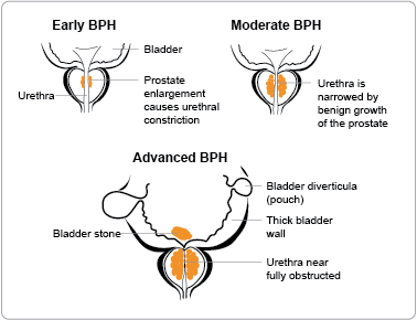 Benign prostatic hypertrophy